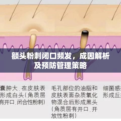 額頭粉刺閉口頻發(fā)，成因解析及預(yù)防管理策略